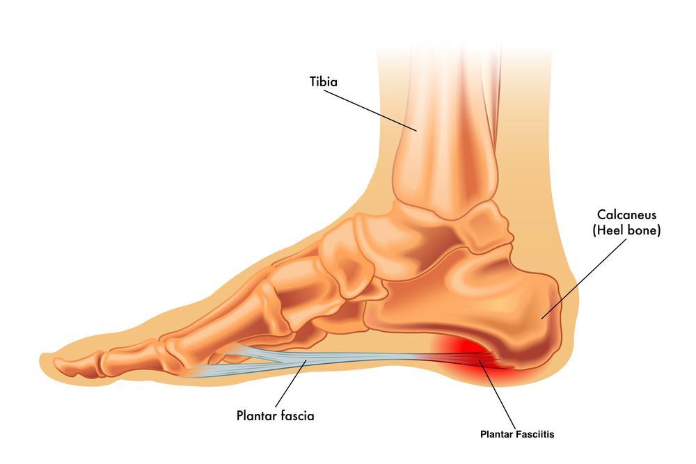 Expert Tips for Swift Relief from Heel Pain