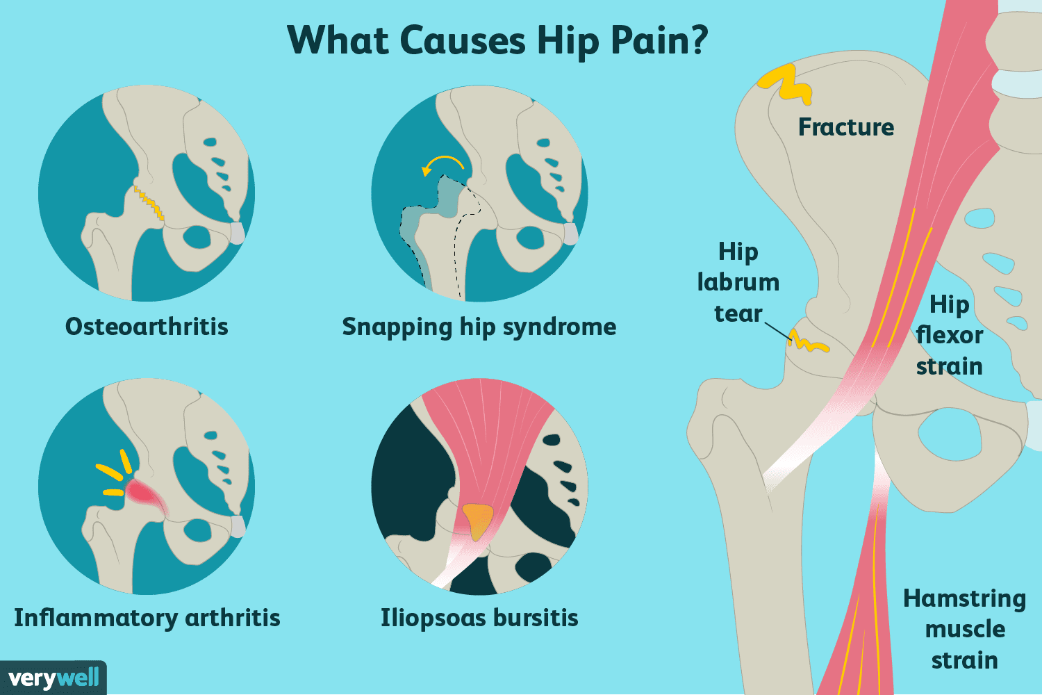 Understanding-Hip-Pain-Causes-Symptoms-and-Solutions TACTICAL X GEAR
