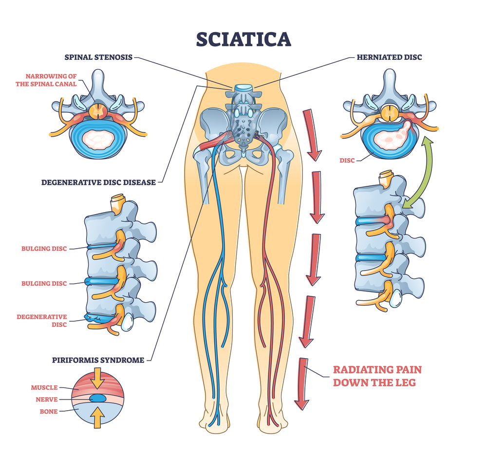 Effective Relief For Your Sciatic Nerve Pain Today!